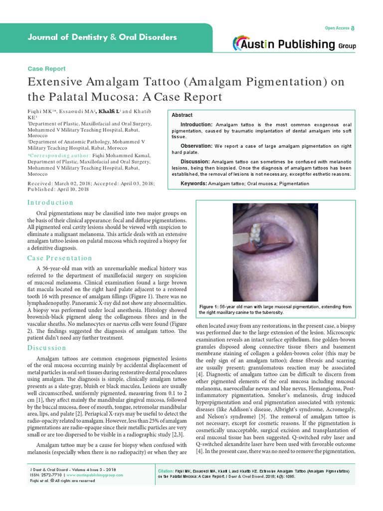 Extensive Amalgam Tattoo (Amalgam Pigmentation) On The Palatal Mucosa