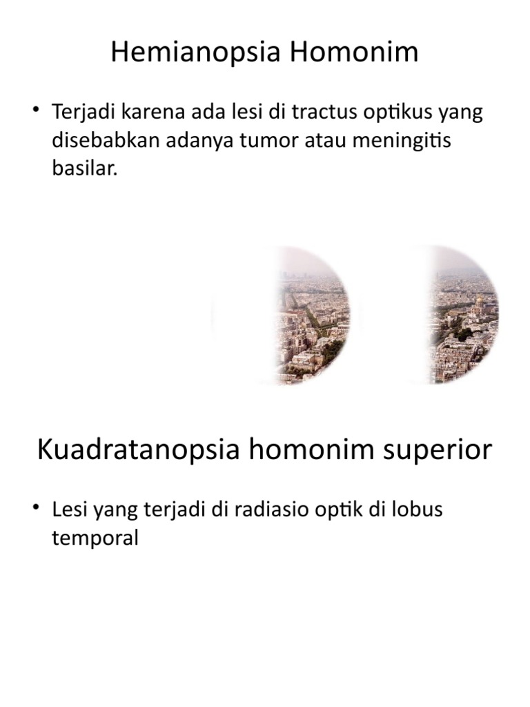 Hemianopsia Homonim PDF