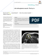 Myositis Ossificans in The Infraspinatus Muscle: The Key To Diagnosis