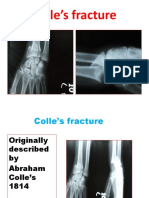 Colle's Fracture