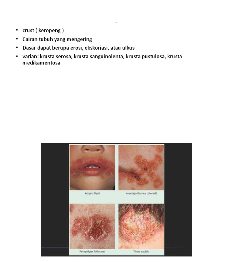 Jenis-Jenis Krusta pada Kulit | PDF | Dewasa Muda