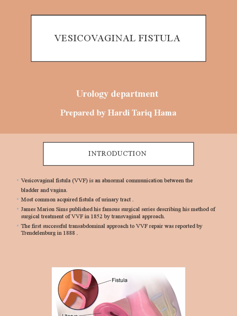 Vesicovaginal Fistula: Urology Department | PDF | Urinary Incontinence ...