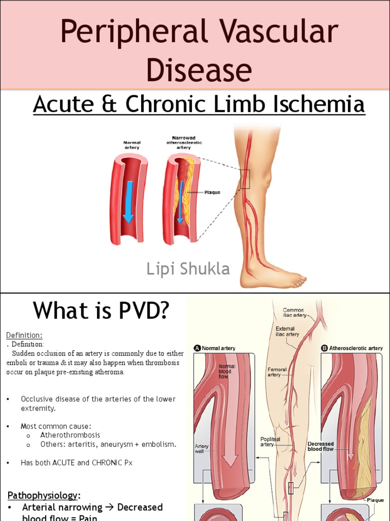 Understanding Peripheral Vascular Disease | PDF | Vascular Diseases ...