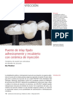 4 Puente de Inlay Fijado Adhesivamente y Recubierto Con Cerámica