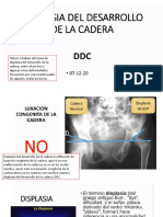 22. displasia del desarrollo de la cadera.pptx