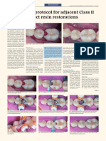 Simplified Protocol For Adjacent Class II Direct Resin Restorations