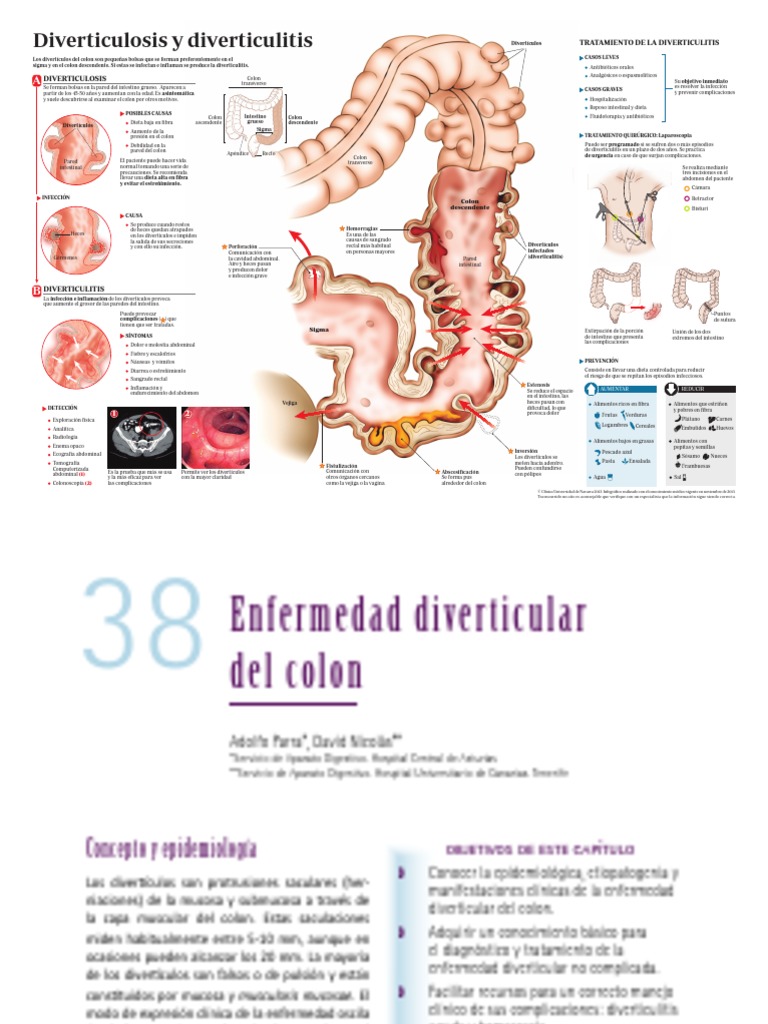 Diverticulosis | PDF | Síndrome del intestino irritable | Medicina CLINICA