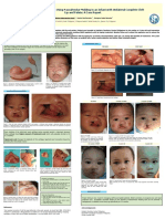 Benefits of Early Treatment Using Nasoalveolar Molding in An Infant With Unilateral Complete Cleft Lip and Palate A Case Report