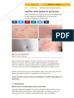Children Rashes and Spots With Pictures - MadeForMums