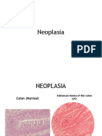 Neoplasia