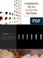 Instalación de Los Implantes Dentales
