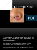 Furuncle of The Nose