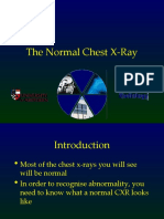 The Normal Chest X-Ray