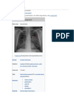 Lung Cancer: This Article Is About Lung Carcinomas. For Other Lung Tumors, See