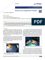 Successful Replantation of An Amputated Thumb: A Case Report