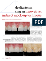 Indirect mock-up technique for predictable diastema closure