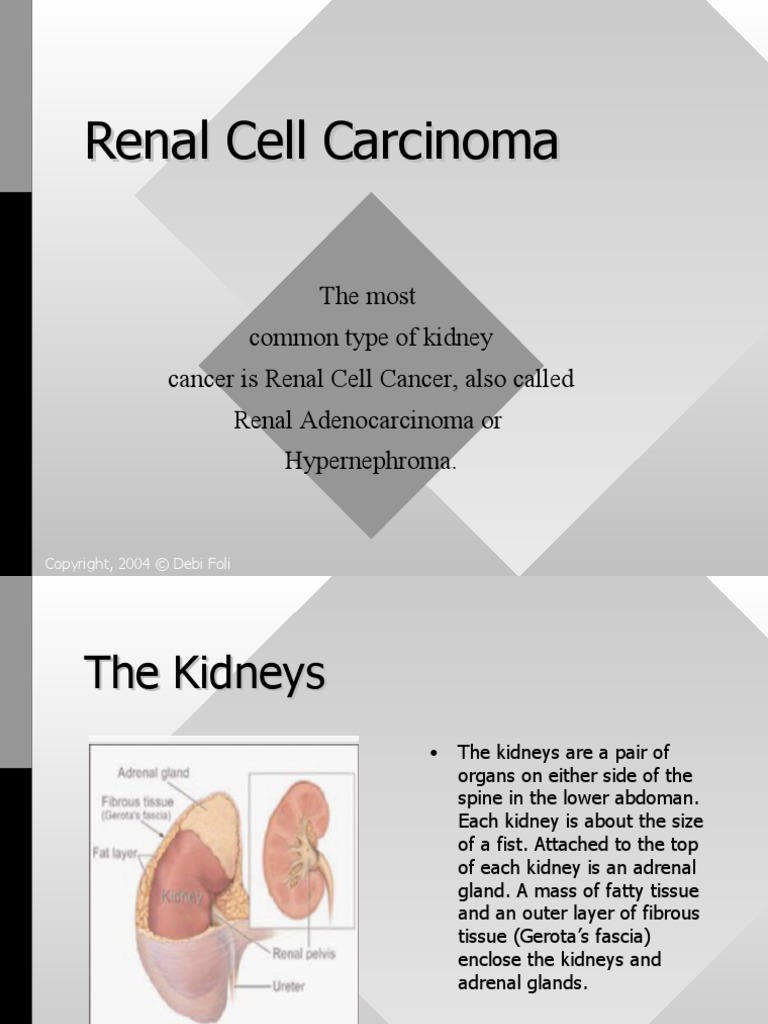 Renal Cell Carcinoma | PDF | Cancer | Kidney