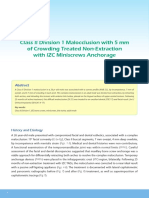 Class II Division 1 Malocclusion With 5 MM of Crowding Treated Non-Extraction With IZC Miniscrews Anchorage