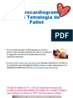 Electrocardiograma-Tetralogia de Fallot