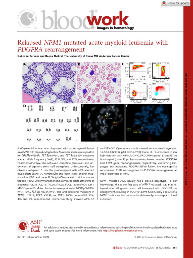 Relapsed NPM1 Mutated Acute Myeloid Leukemia With PDGFRA Rearrangement ...