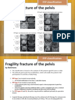 Fragility Fracture of The Pelvis: by Rommens