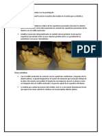 Análisis modelo paralelígrafo para prótesis dental