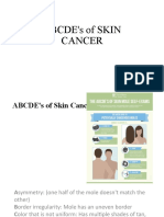 ABCDE's of SKIN CANCER