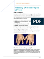 Syndactyly (Webbed Fingers and Toes)