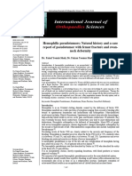 Hemophilic Pseudotumors: Natural History and A Case Report of Pseudotumor With Femur Fracture and Swan-Neck Deformity