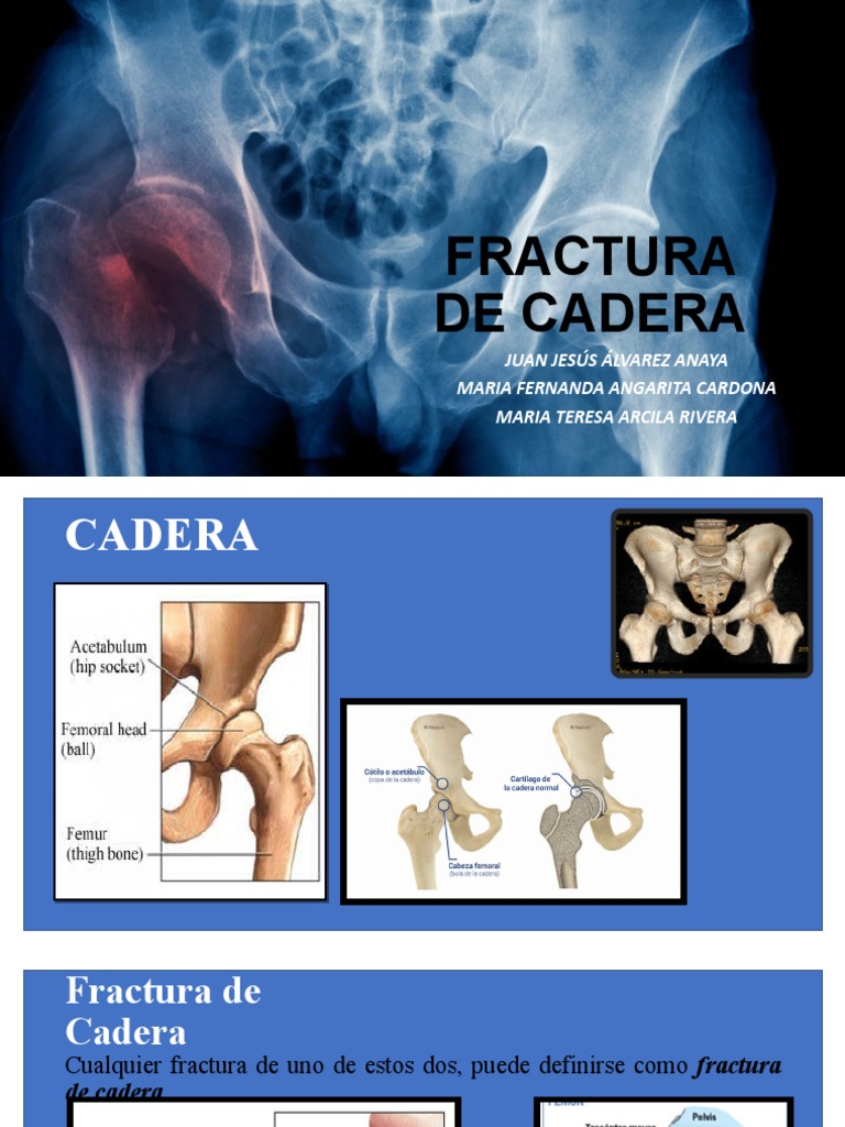 Fractura de Cadera | PDF | Cirugía | Medicina CLINICA