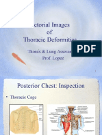 Pictorial Images of Thoracic DeformitiesSV
