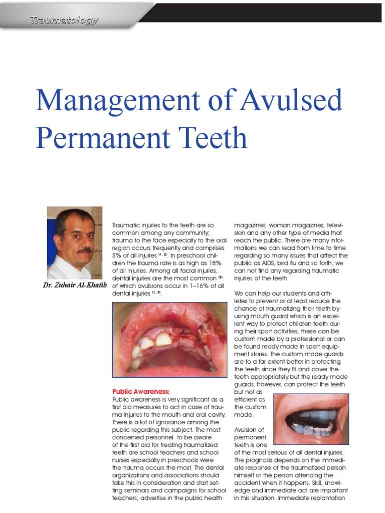 Management of Avulsed Permanent Teeth | PDF | Human Tooth | Dentistry