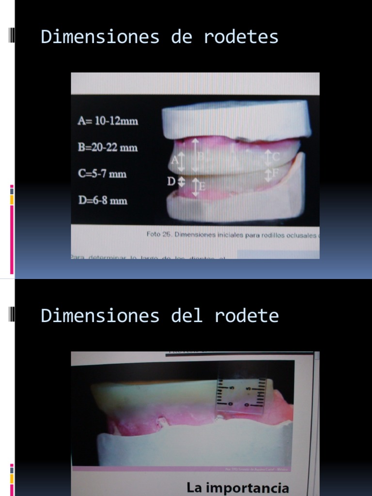 Medidas de Rodetes en Prótesis Total | PDF