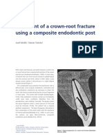 Treatment of a crown-root fracture