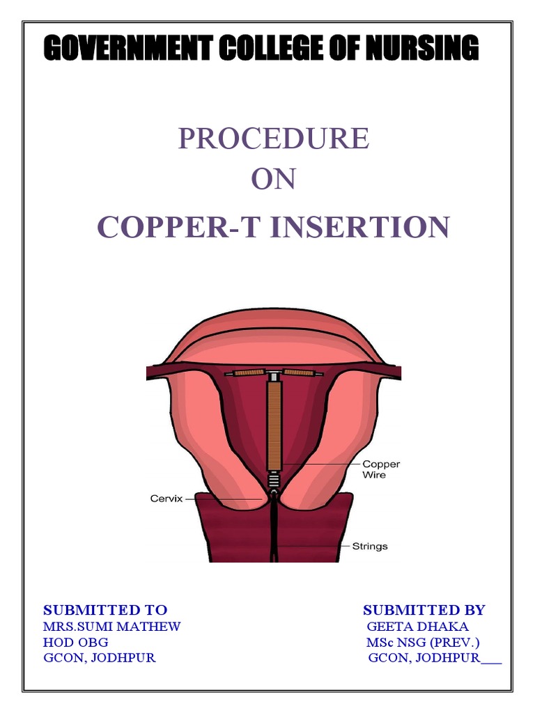 Copper-T Insertion Procedure | PDF | Uterus | Vagina