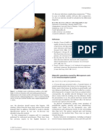 M. abscessus infections complicating acupuncture