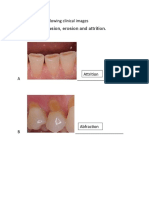 Non Carious Tooth Lesions With Images