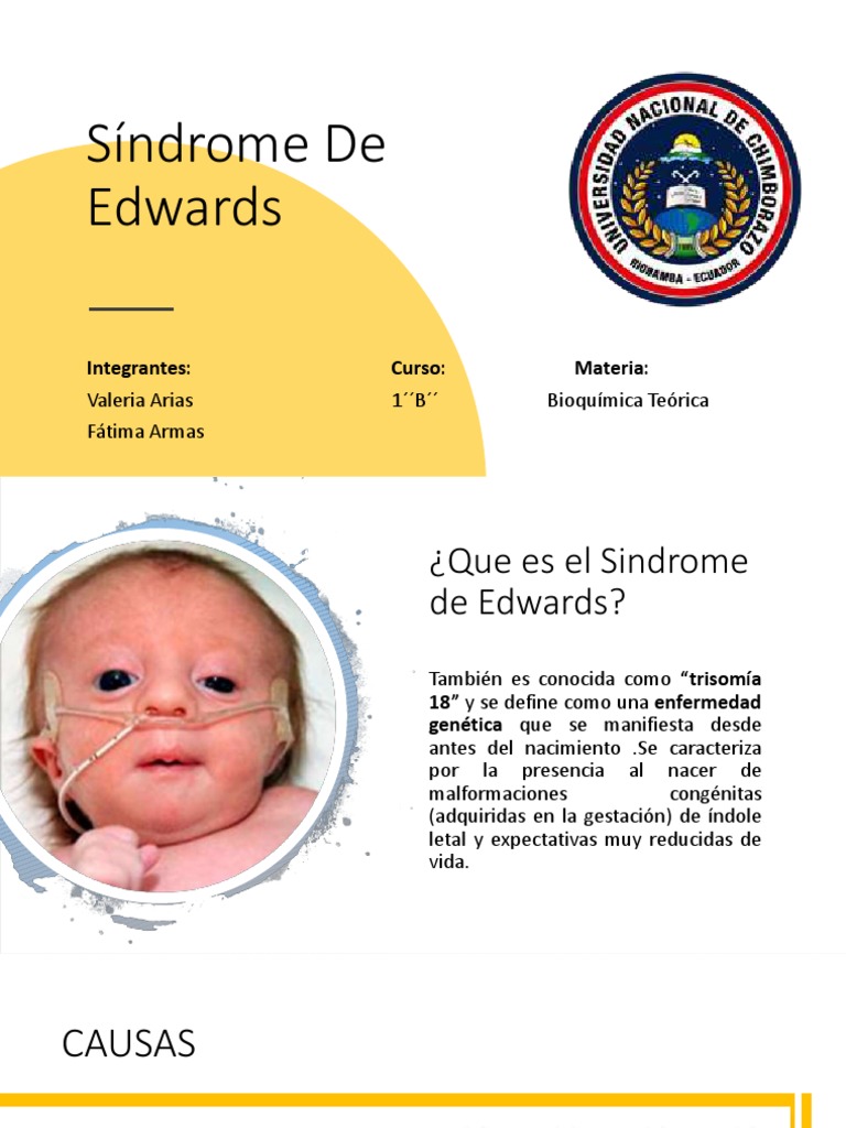 Síndrome de Edwards | PDF | Nucleo celular | Enfermedades y trastornos ...
