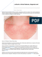 Diagnosing & Managing Chronic Hives