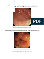 Gambaran Endoskopi Dan Histopatologi Skistosomiasis Pada Intestinal