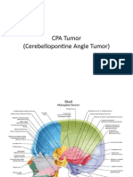 CPA Tumor (Cerebellopontine Angle Tumor)