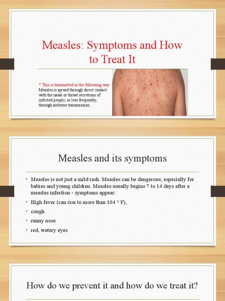 Measles Symptoms and Treatment Guide | PDF