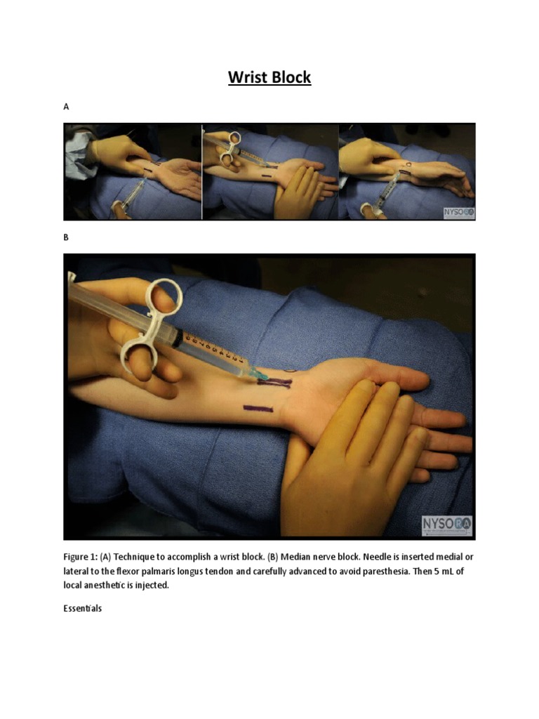 Comprehensive Guide to Wrist Block Technique | PDF | Thumb | Hand