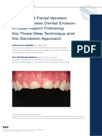 Palatal and Facial Veneers To Treat Severe Dental Erosion - A Case Report Following The Three-Step Technique and The Sandwich Approach.