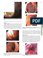 Dieulafoy's Lesion