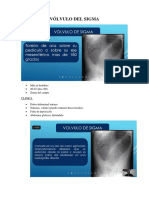 Vólvulo Del Sigma-Trauma de Torax