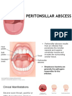 Peritonsillar Abscess