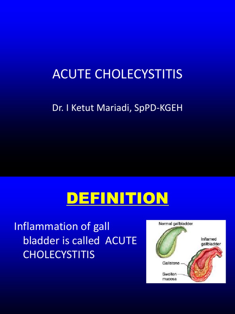 Acute Cholecystitis SMT IV 2021 PDF Gallbladder Digestive System