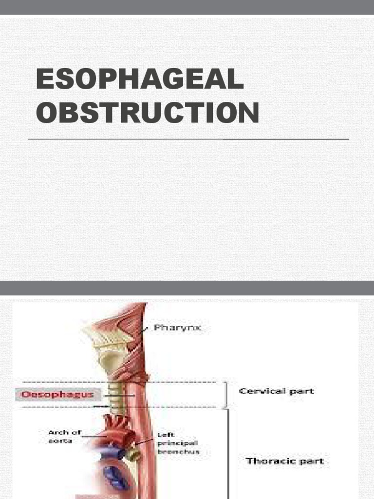 Esophageal Obstruction | PDF | Esophagus | Clinical Medicine