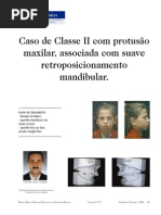Caso de Classe II com protusão maxilar, associada com suave retroposicionamento mandibular